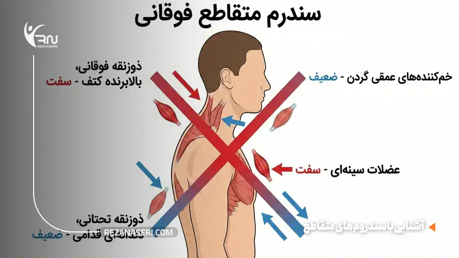 سندرمهای متقاطع (Crossed Syndromes)
